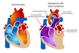 Ảnh 1 của Hội chứng thiểu sản tim trái